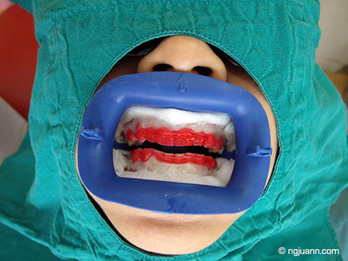 Bangkok Smiles Dental review
