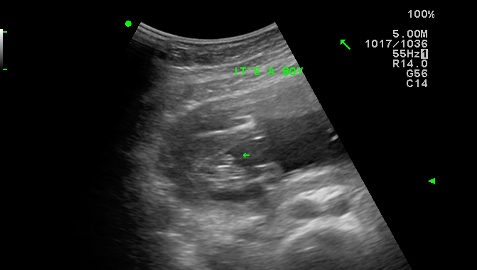 Baby Scan: Week 16 pregnancy gender reveal